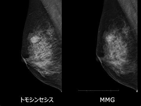 微細石灰化の集簇